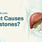What Causes Gallstones? The Bile Imbalance Behind the Stones